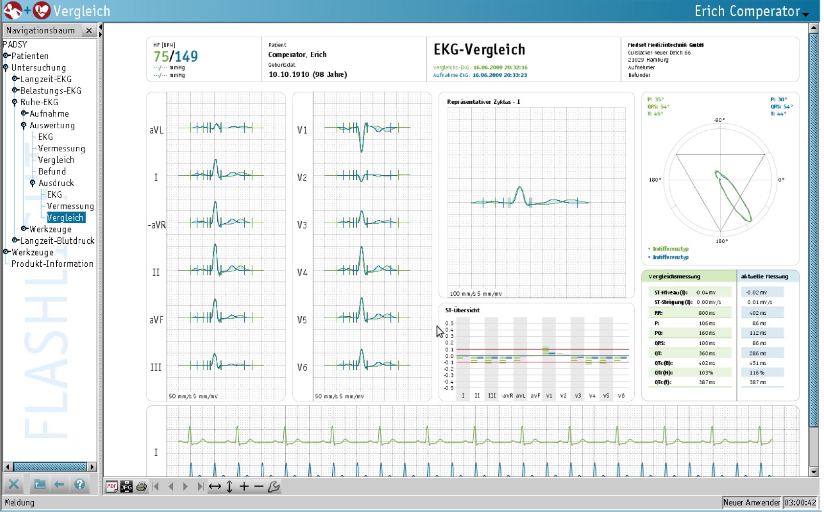 EKG-Vergleich EKG-Vergleich